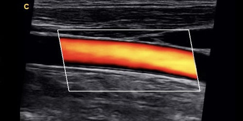 Q9 Color Doppler Carotid Artery Vascular Ultrasounds