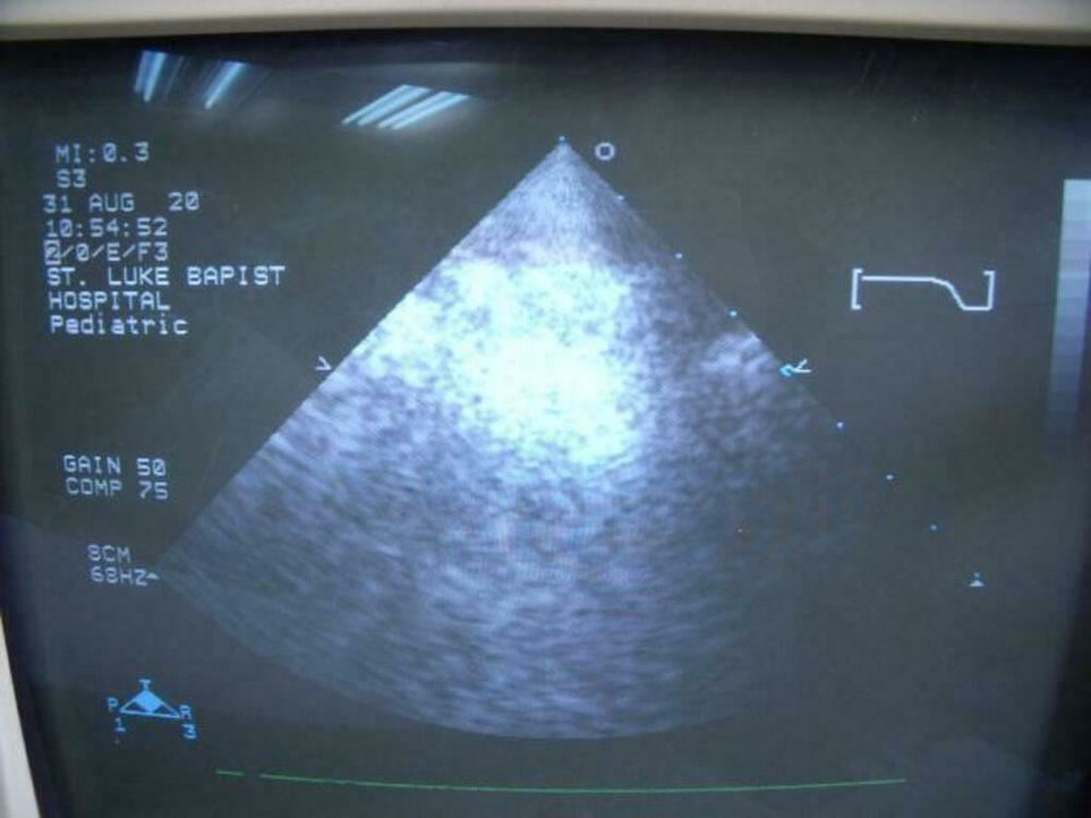 
                  
                    Philips 21311A S3 Ultrasound Probe | PR5323
                  
                