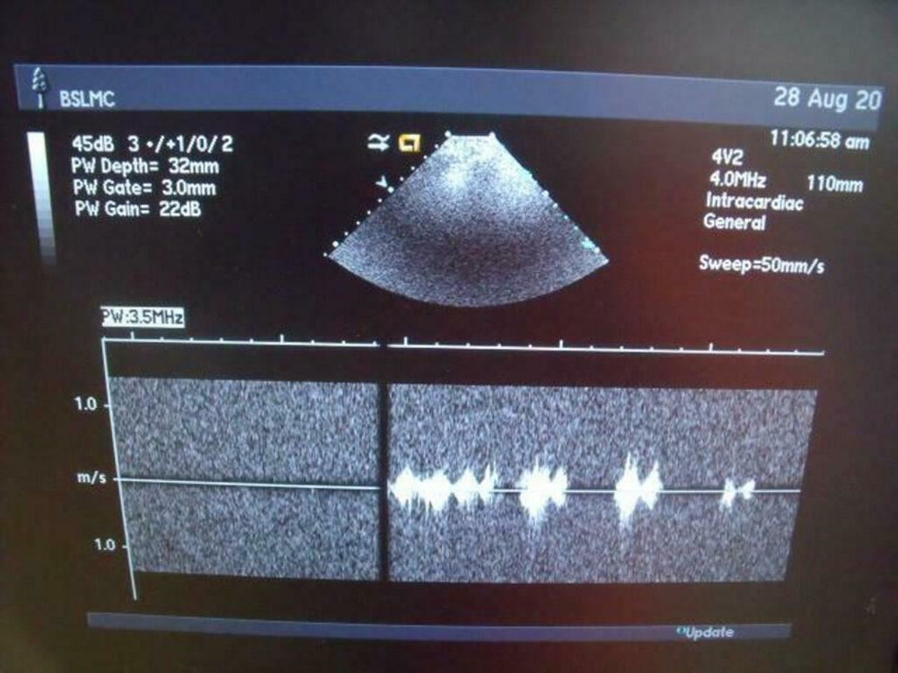 
                  
                    ACUSON 47446-93742503 4V2 ULTRASOUND PROBE | PR5320
                  
                
