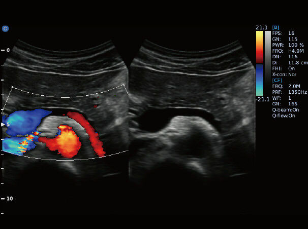 
                  
                    Chison EBit 50, 2D Steer, Super Needle, B/BC, FHI, Battery, Portable, 15" Screen
                  
                