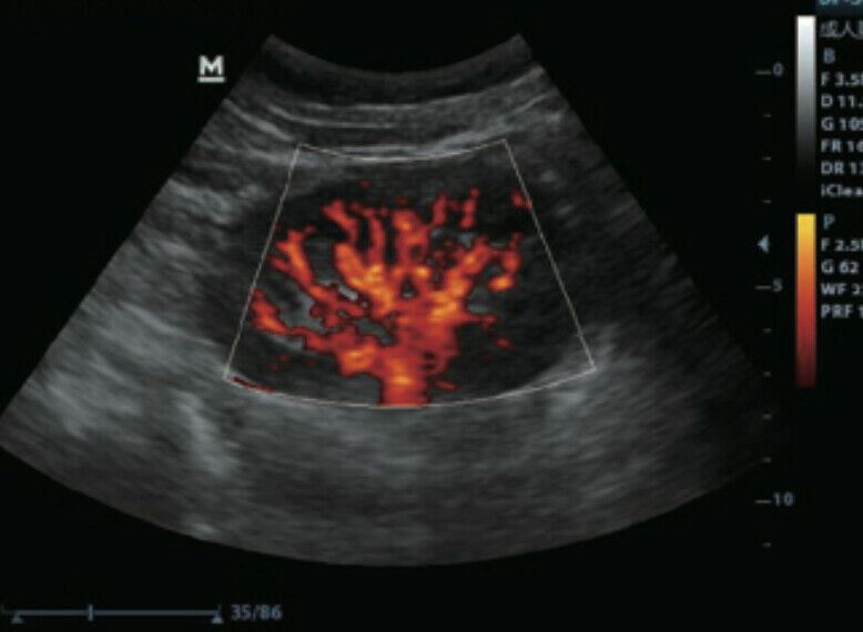 
                  
                    Color Doppler Ultrasound & One linear Array Probe
                  
                