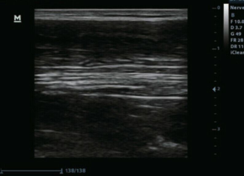 
                  
                    Color Doppler Ultrasound & One linear Array Probe
                  
                