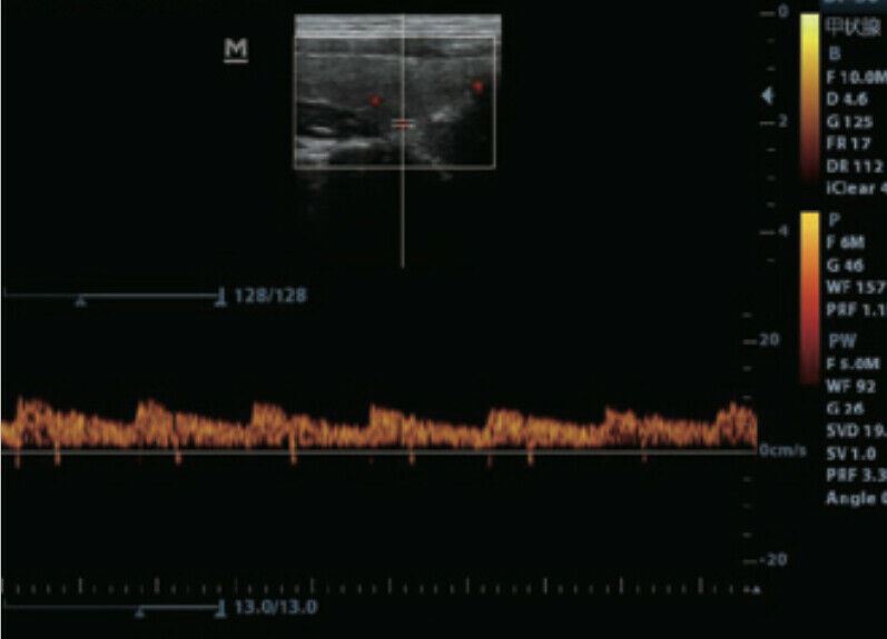 
                  
                    Color Doppler Ultrasound & One linear Array Probe
                  
                