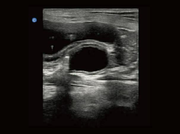 
                  
                    Chison eBit10 Amazing Quality Ultrasound with Linear Array Probe 5.0-15.0Mhz
                  
                