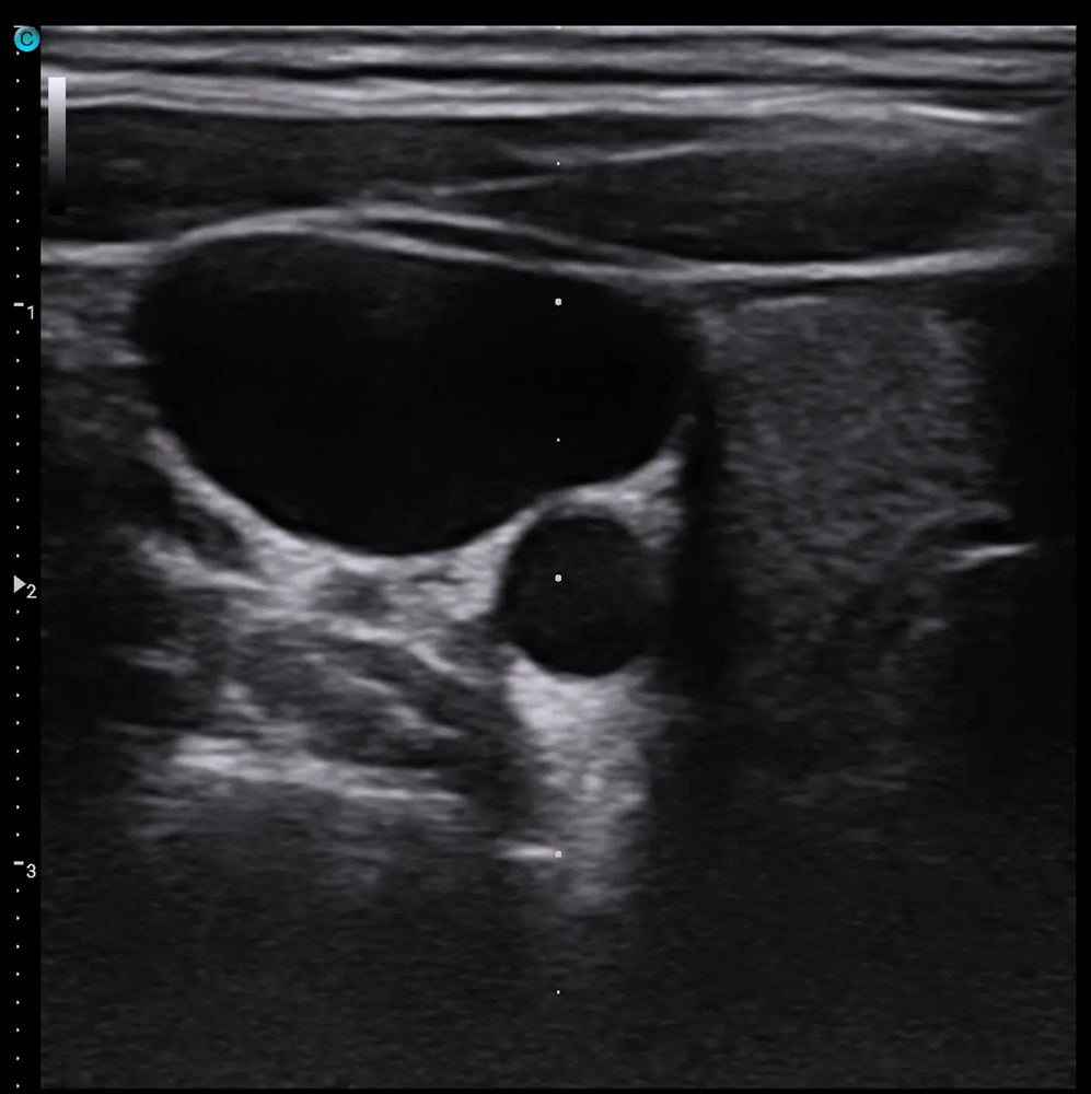
                  
                    Chison SonoEye P1 Linear Array Mobile Smartphone Handheld Ultrasound Internal Jugular | KeeboMed
                  
                