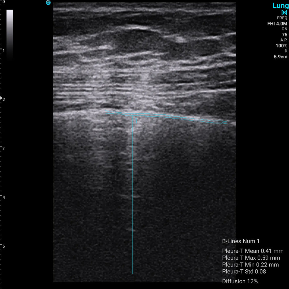 
                  
                    Chison SonoEye P1 Linear Array Mobile Smartphone Handheld Ultrasound Lung | KeeboMed
                  
                