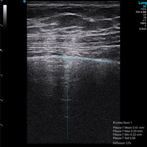 
                  
                    Chison SonoEye P1 Linear Array Mobile Smartphone Handheld Ultrasound Lung | KeeboMed
                  
                