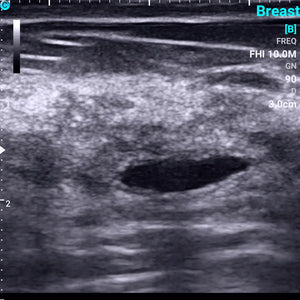 
                  
                    Chison SonoEye P1 Linear Array Mobile Smartphone Handheld Ultrasound Thyroid Tumor | KeeboMed
                  
                