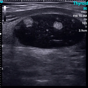 
                  
                    Chison SonoEye P1 Linear Array Mobile Smartphone Handheld Ultrasound Thyroid Tumor | KeeboMed
                  
                