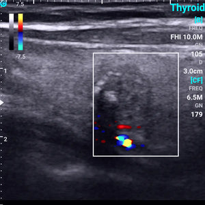 
                  
                    Chison SonoEye P1 Linear Array Mobile Smartphone Handheld Ultrasound Thyroid Tumor | KeeboMed
                  
                