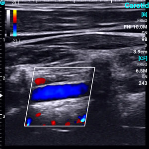 
                  
                    Chison SonoEye P1 Linear Array Mobile Smartphone Handheld Ultrasound Vertebral Artery | KeeboMed
                  
                