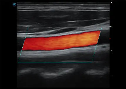 
                  
                    SonoScape P20 Trolley Color Doppler Ultrasound
                  
                