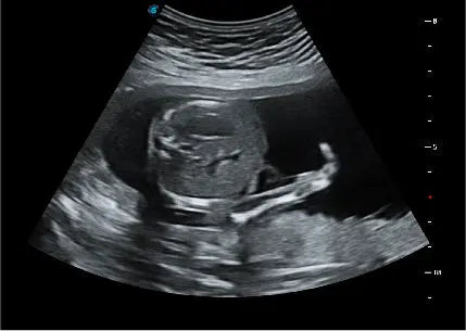 
                  
                    SonoScape P20 Trolley Color Doppler Ultrasound
                  
                
