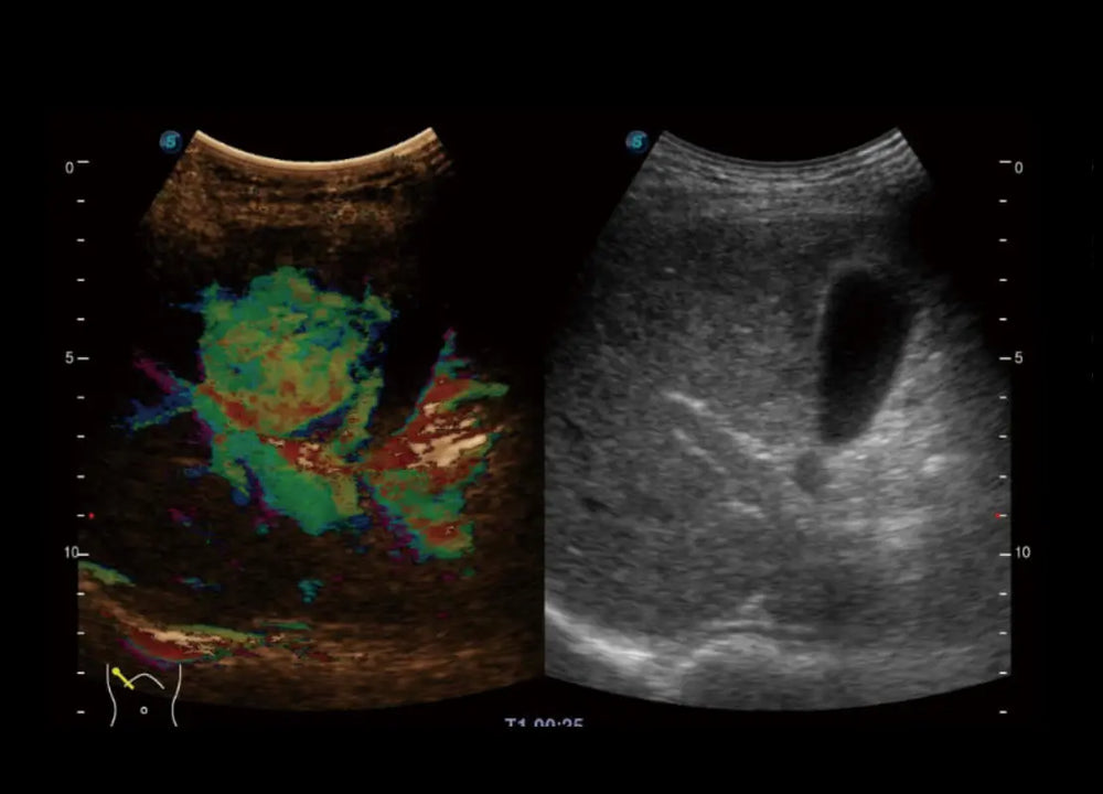 
                  
                    SonoScape P60 Trolley Color Doppler
                  
                