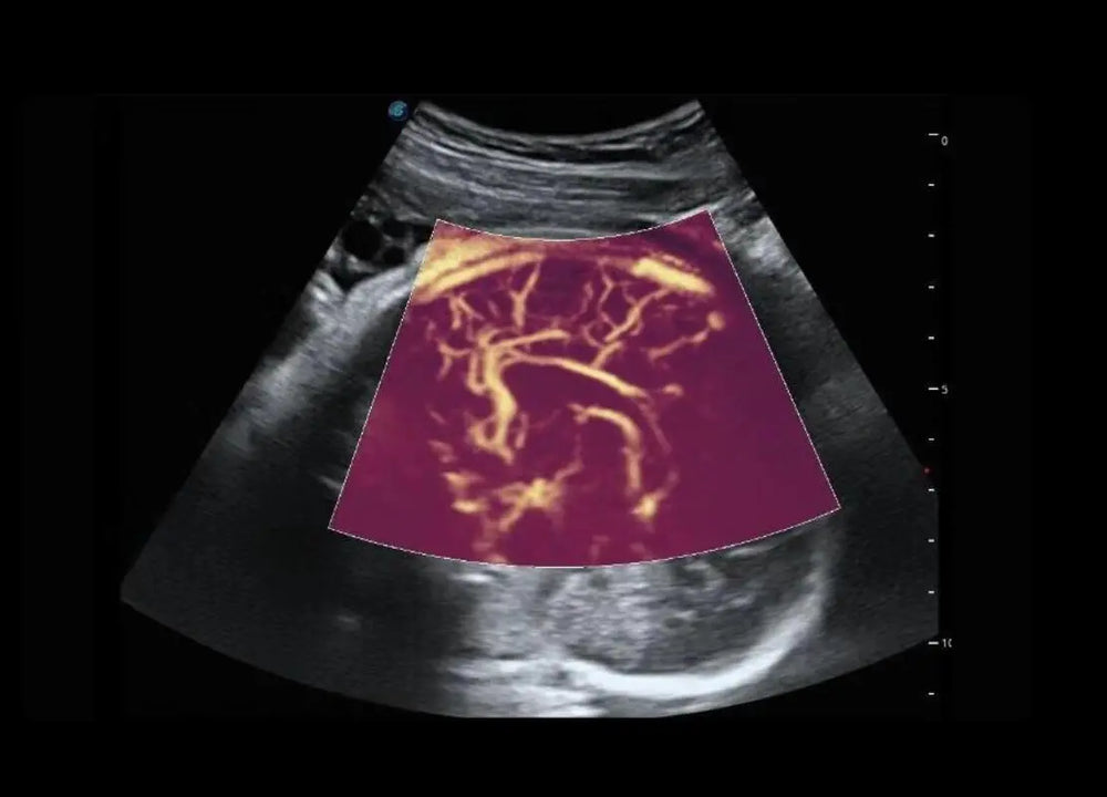 
                  
                    SonoScape P60 Trolley Color Doppler
                  
                