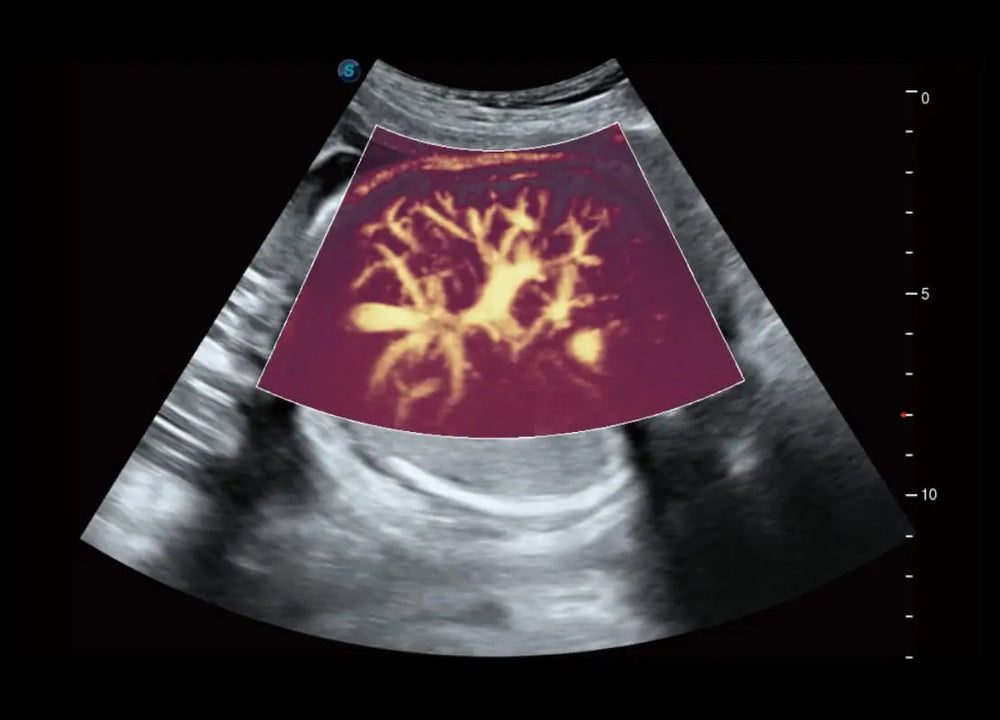 
                  
                    SonoScape P60 Exp Color Doppler
                  
                