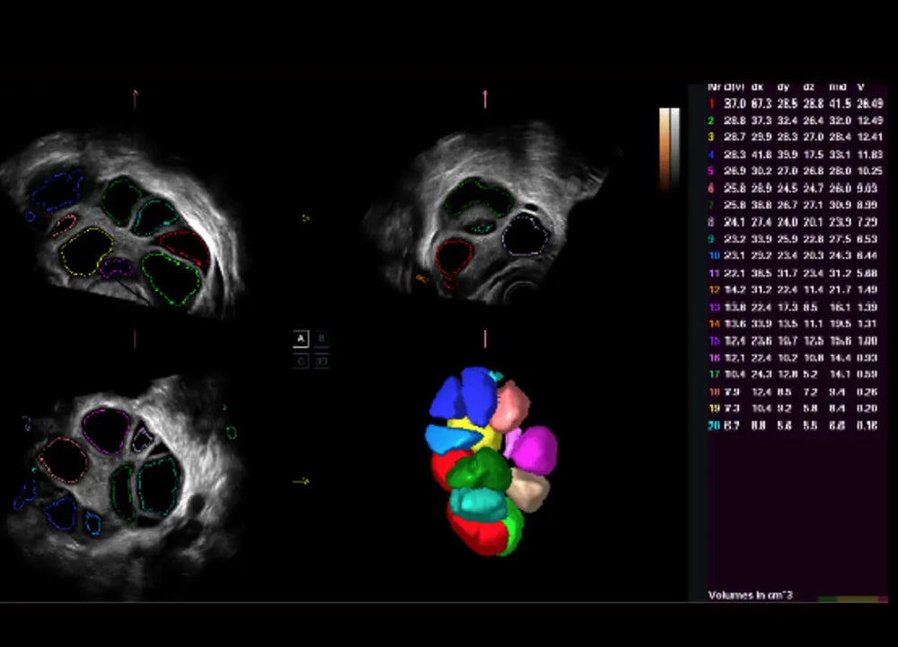 
                  
                    SonoScape P60 Exp Color Doppler
                  
                