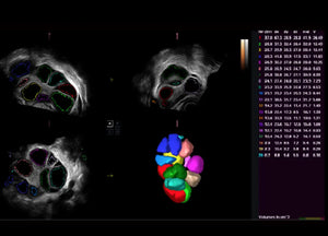 
                  
                    SonoScape P60 Exp Color Doppler
                  
                