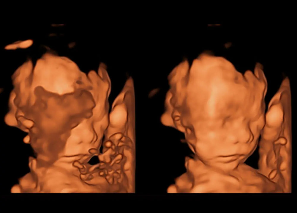 
                  
                    SonoScape P60 Exp Color Doppler
                  
                