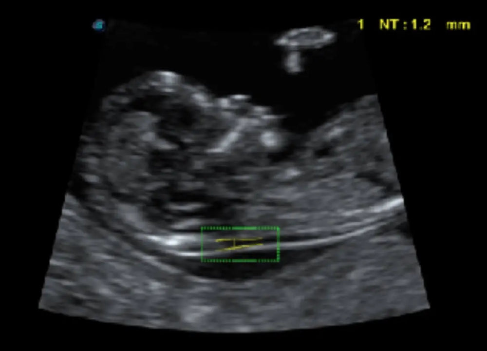 
                  
                    SonoScape P60 Exp Color Doppler
                  
                