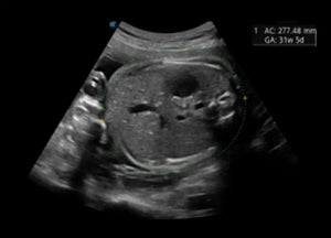
                  
                    SonoScape P60 Exp Color Doppler
                  
                