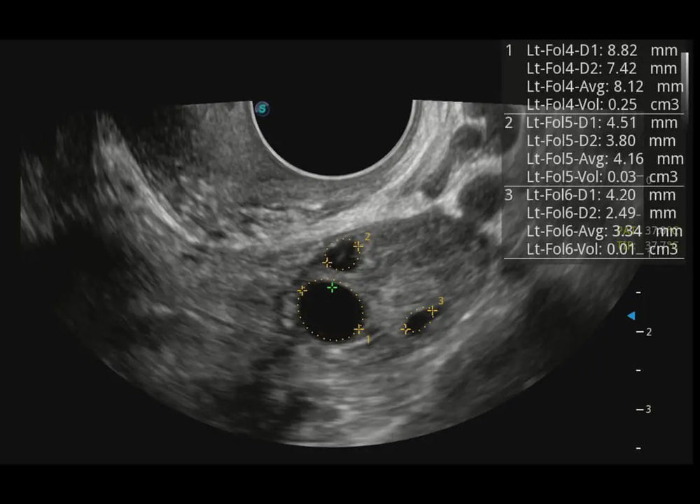 
                  
                    SonoScape P60 Exp Color Doppler
                  
                