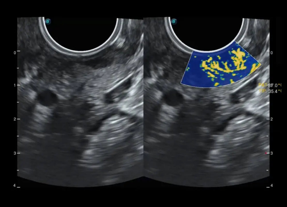 
                  
                    SonoScape P60 Exp Color Doppler
                  
                