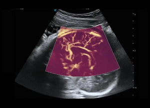 
                  
                    SonoScape P60 Exp Color Doppler
                  
                