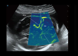 
                  
                    SonoScape P60 Exp Color Doppler
                  
                